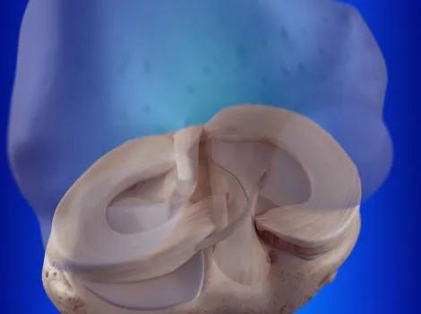 Jak vzniká zranění menisku